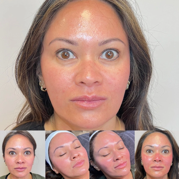 Facial Treatment Before and After Images | Peninsula Plastic Surgery | MD and DE