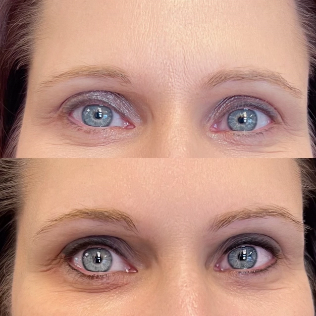 Brow linting Before and After Images 2 | Peninsula Plastic Surgery | MD and DE