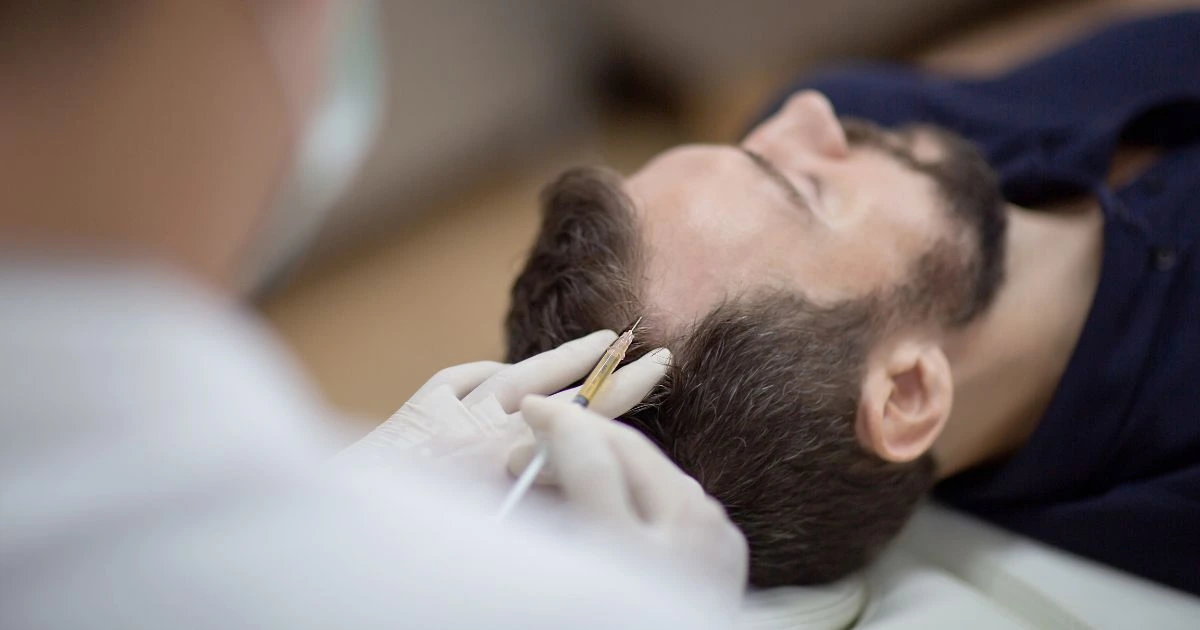 Close-up of non-surgical Hair Restoration procedure using Platelet-Rich Plasma (PRP) at Peninsula Plastic Surgery PC