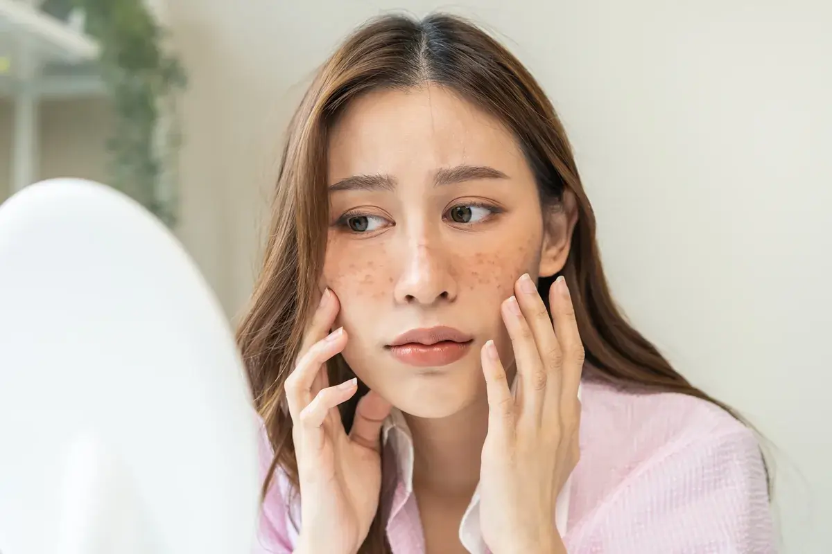 Chemical peel treatment for hyperpigmentation, dark spots, and uneven skin tone on the face