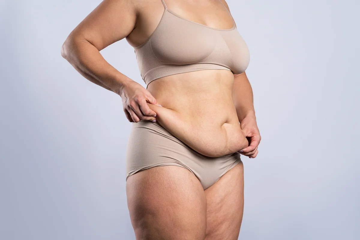 Tummy tuck for loose abdominal skin and stubborn belly fat