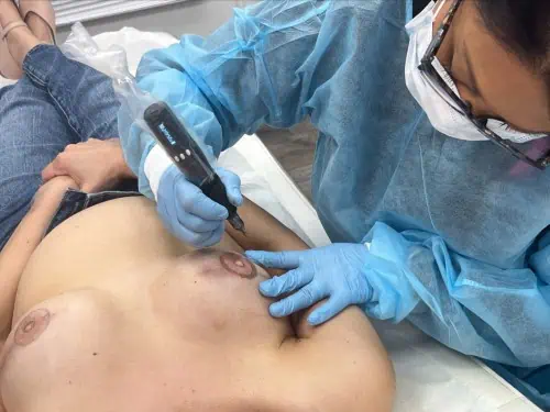 Clinical photo of a professional performing areola tattooing on a patient’s chest with outlines visible on both breasts.